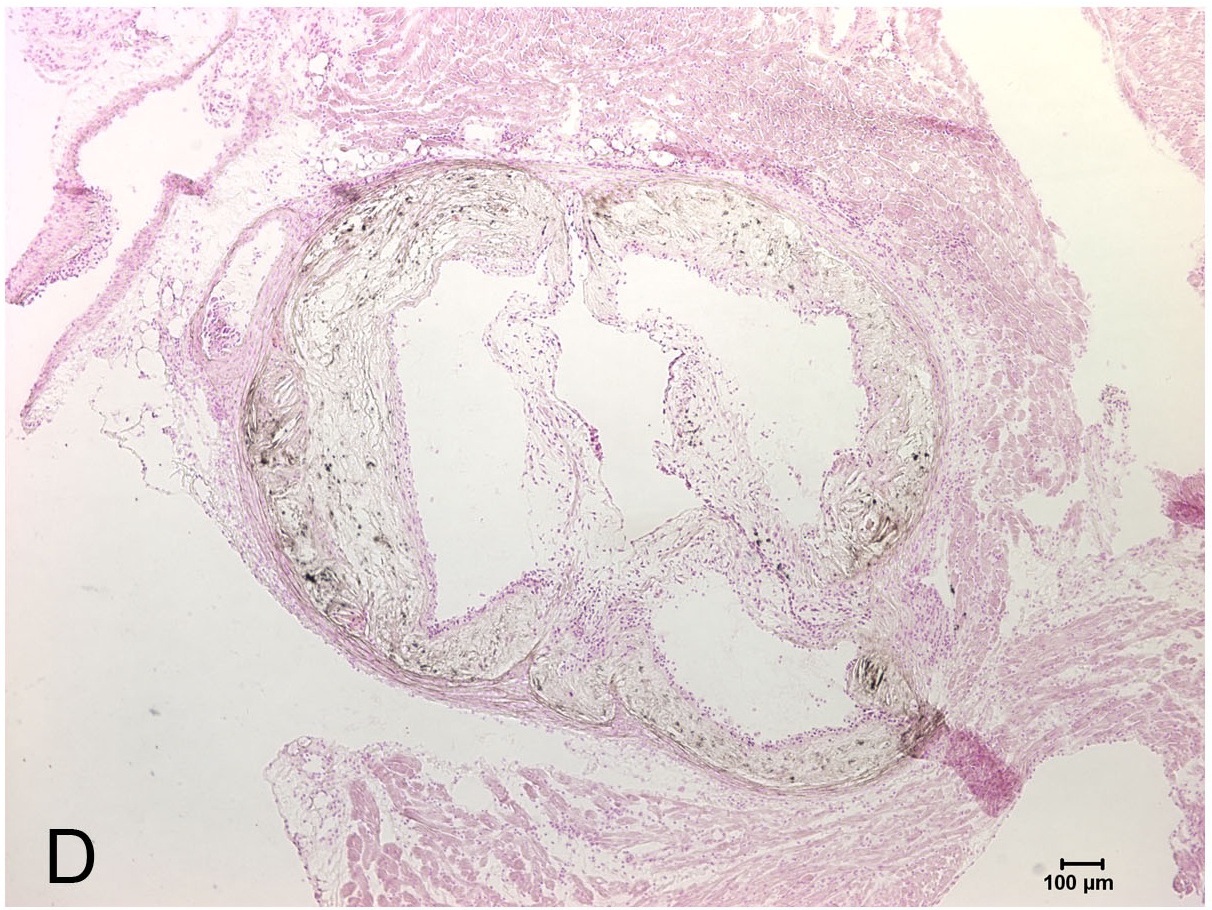 Von Kossa Stain for Calcification