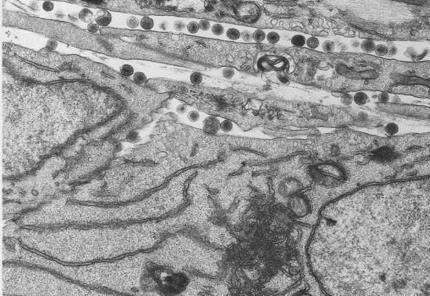 Virus Infected Fibroblast Cells (TEM)