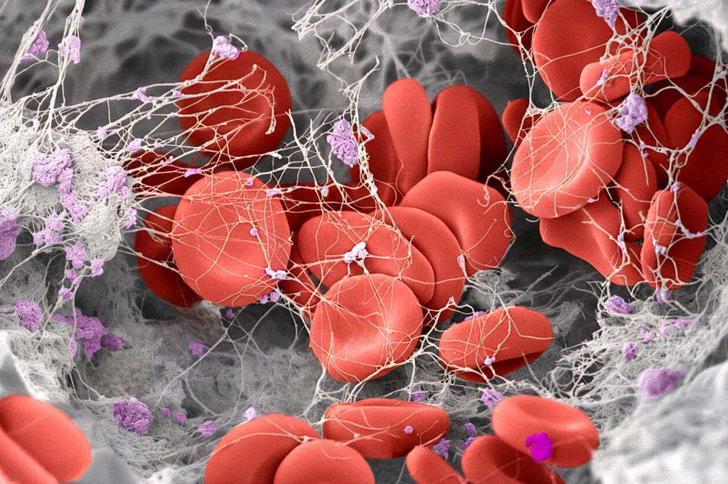 Colored scanning electron microscope (SEM) image of a human blood clot